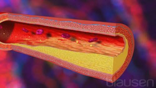 Løsning av plakk, animasjon