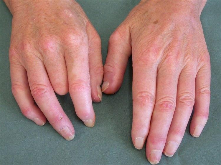 Fotoet viser nærbilde av to hender med tegn til Sklerodaktyli