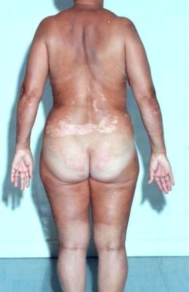 283-2-psoriasis-rygg-mild