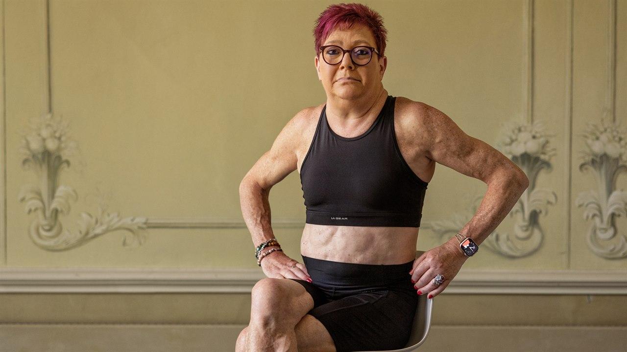 Illustrasjonsfoto viser kvinne med lipodystrofi.