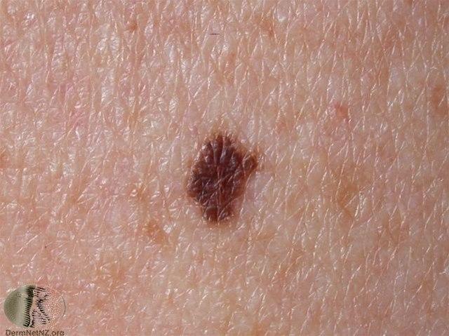 Fotoet viser føflekk