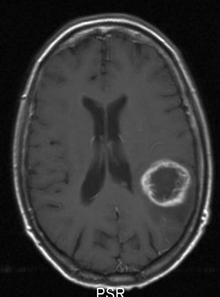 glioblastom who grad iv 2