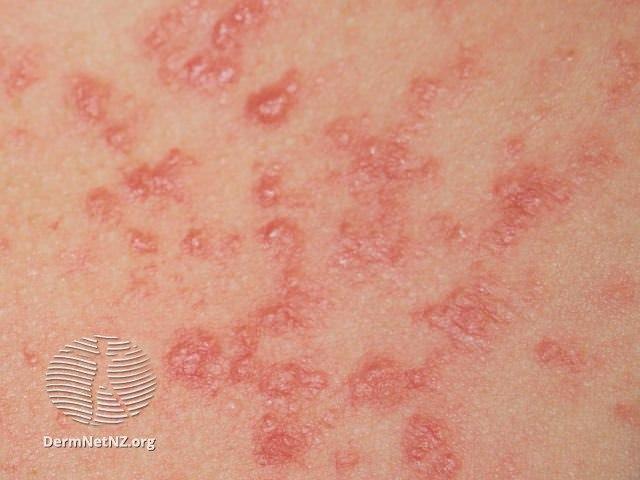 Fotoet viser nærbilde av hud med soleksem