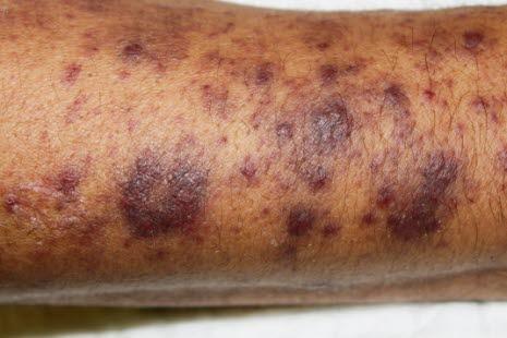 Thrombocytopenic purpura