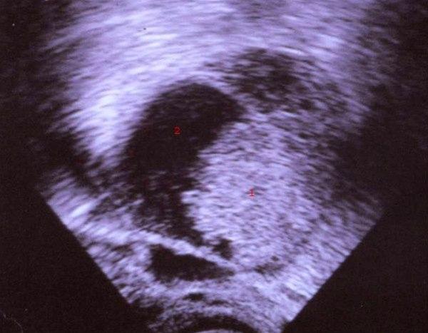 Endometroid adenocarcinom