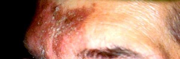 Eksem ved nesevingene, i nasolabialfuren, langs øyenvippene, i øyenbrynene, i hårbunnen og langs hårfeste, i øregangene og bak ørene, presternalt og interskapulært er typisk hos unge og voksne.