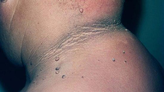 Acanthosis nigricans