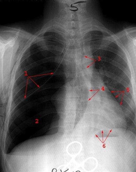 Ventilpneumothorax