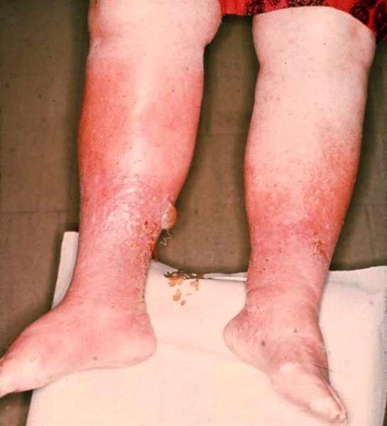 Eksempel på inflammasjon