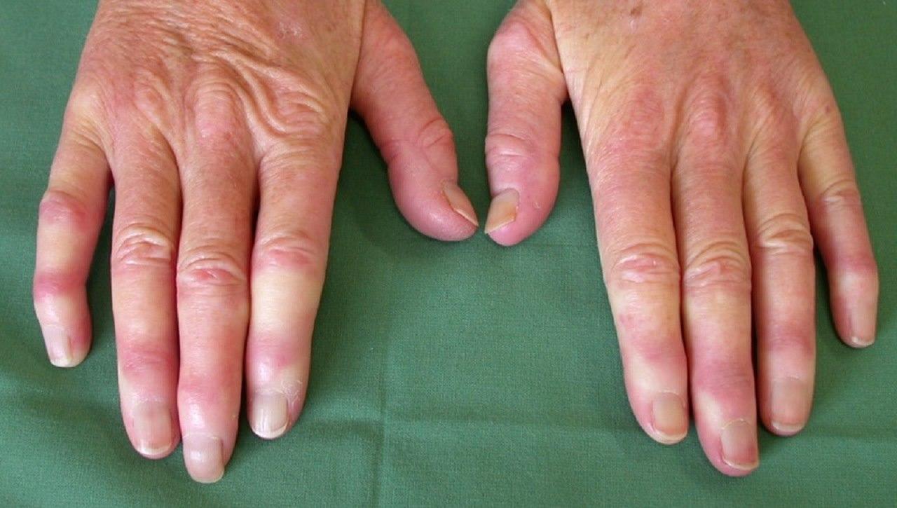 Raynauds fenomen 1280x725