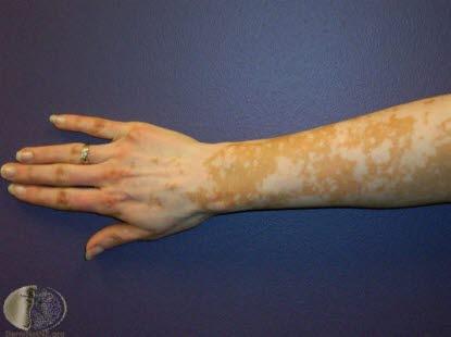 Vitiligo 3