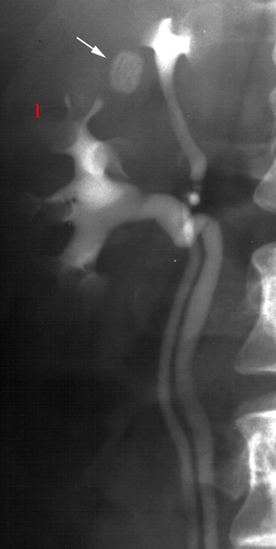 Dobbeltanlegg (urografi)