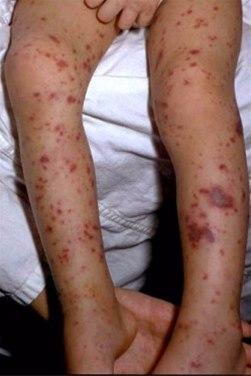 Petekkier (smittsom hjernehinnebetennelse)