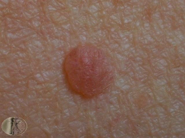 Fotoet viser nevus, dermal (hos eldre)