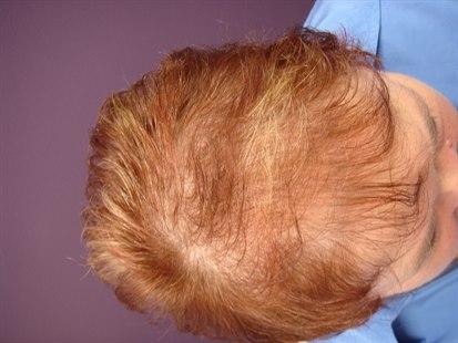 Alopesi, diffus