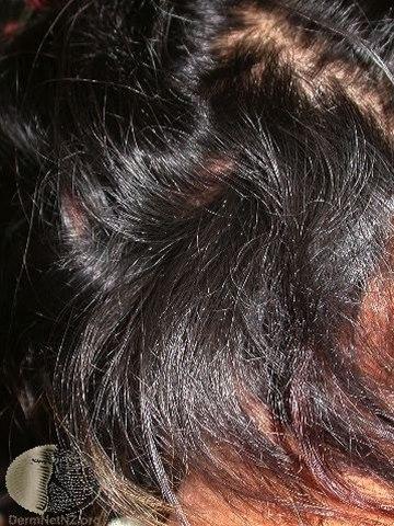 Fotoet viser lus i hodebunnen