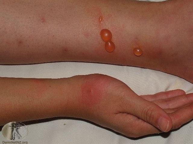 Fotoet viser myggstikk, bulløs reaksjon