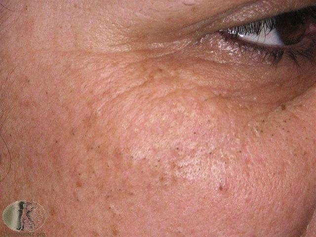 Fotoet viser akne, åpne komedoner