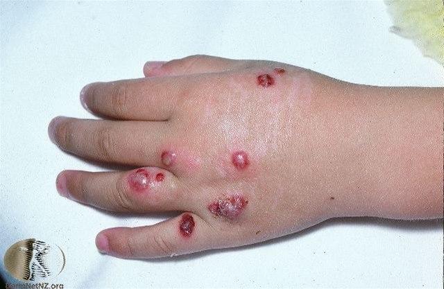 Fotoet viser orfvirussykdom