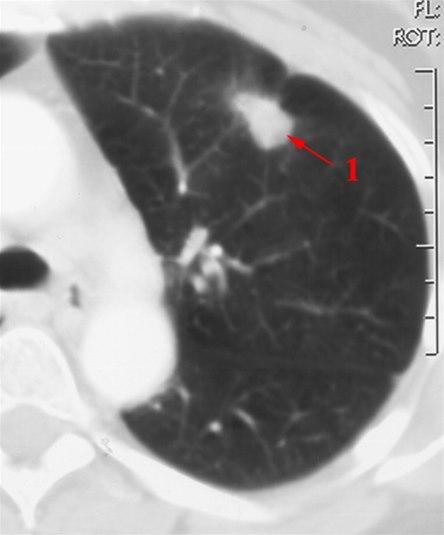 CT-bilde av lunge med svulst