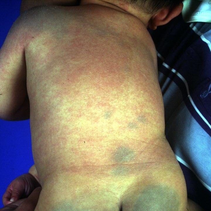 Fotoet viser pigmenterte hudlesjon på ryggområde hos et barn.