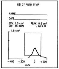 Tympanogram, normalt