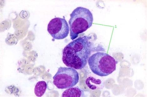Plasma cells, multiple myeloma, myelomatosis