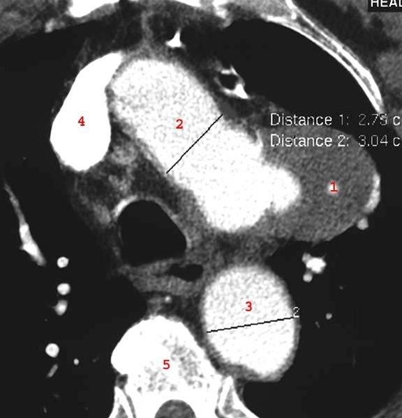 Aneurisme arcus aorta (CT)