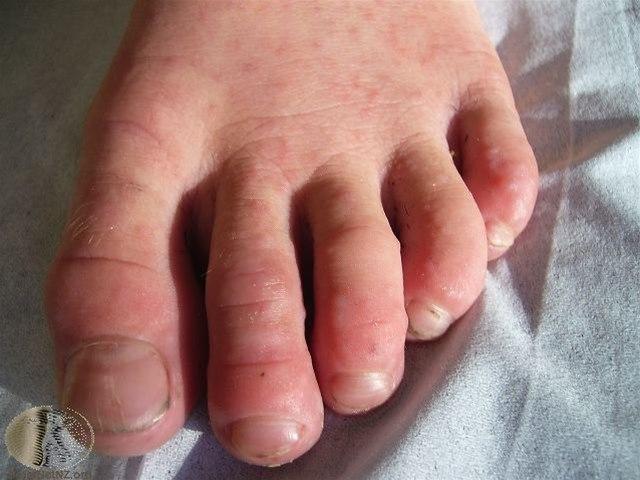 Fotoet viser hånd-, fot- og munnsykdom 2