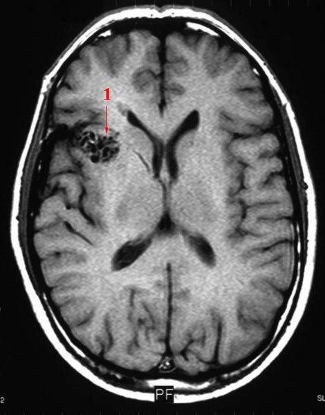 AV-malformasjon (MR)