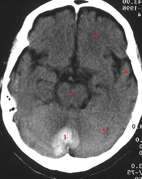 Hematom i cerebellum