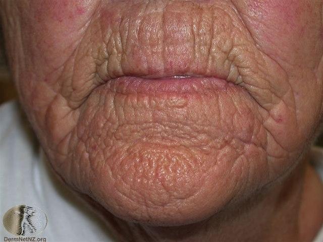 Fotoet viser rynker (uttalt elastose) 