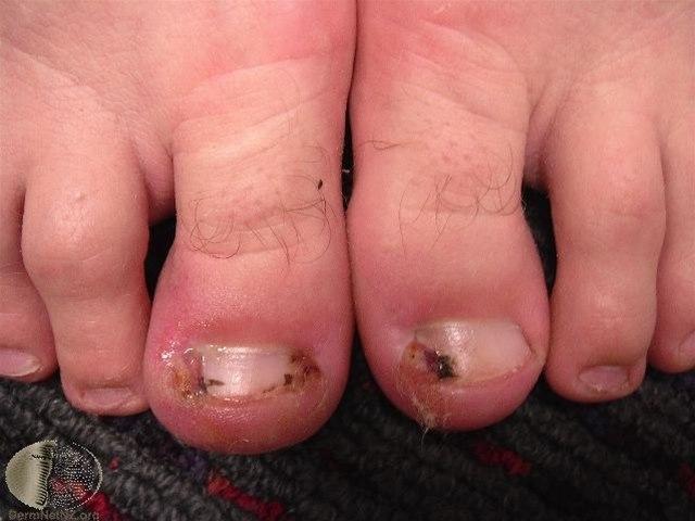 Fotoet viser inngrodd tånegl (betent) 