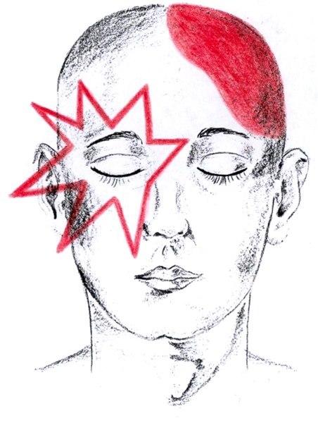 Hodepine - migrene, frontalt