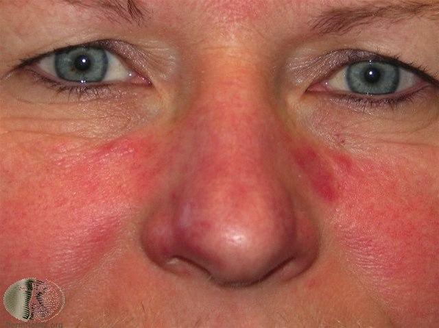 Fotoet viser rosacea, mild i ansikt