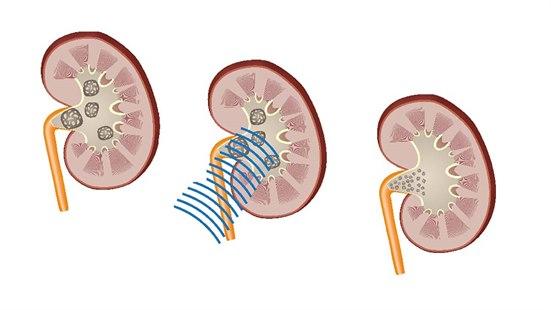 shockwave lithotripsy