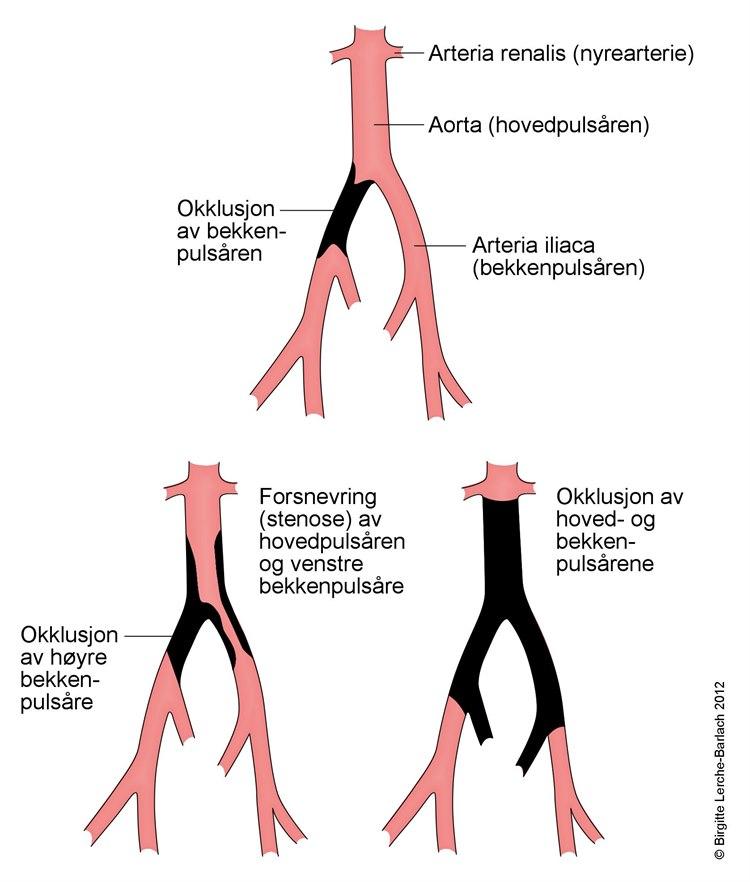 Blodpropp i bekkenet/låret