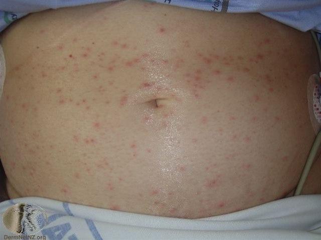 Fotoet viser vannkopper på mage i tidlig fase