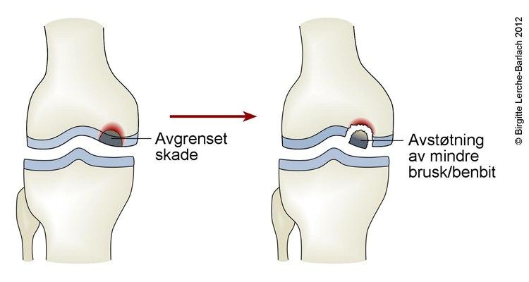 Kne - osteochondritt