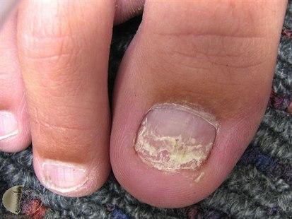 Fotoet viser neglesopp i stortå