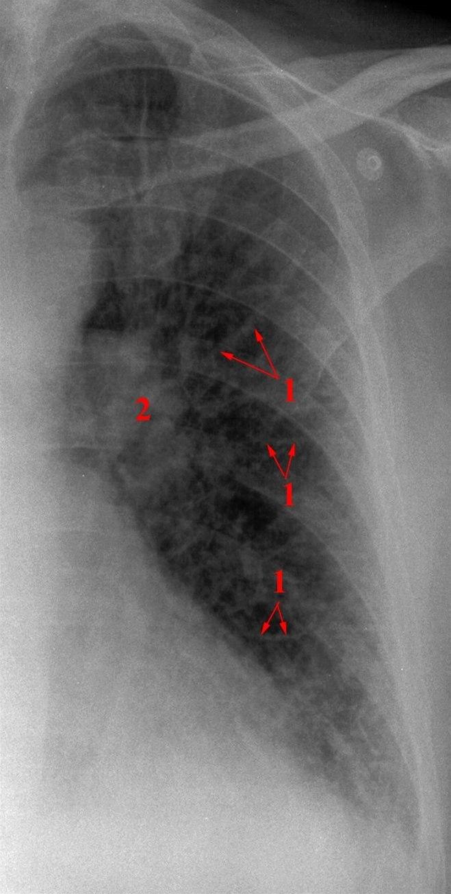 Hjertesvikt, moderat