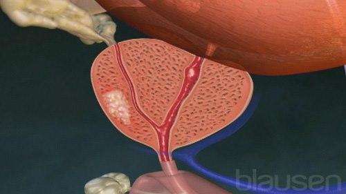 Cancer of the prostate