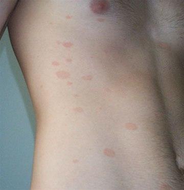 Et mildt tilfelle av pityriasis rosea.