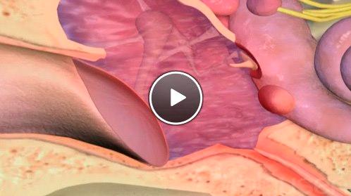 Mellomørebetennelse