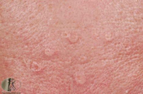 Aterom i huden IKKE BRUK