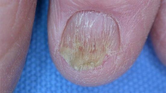 Bilde av tå med skadet eller syk negl