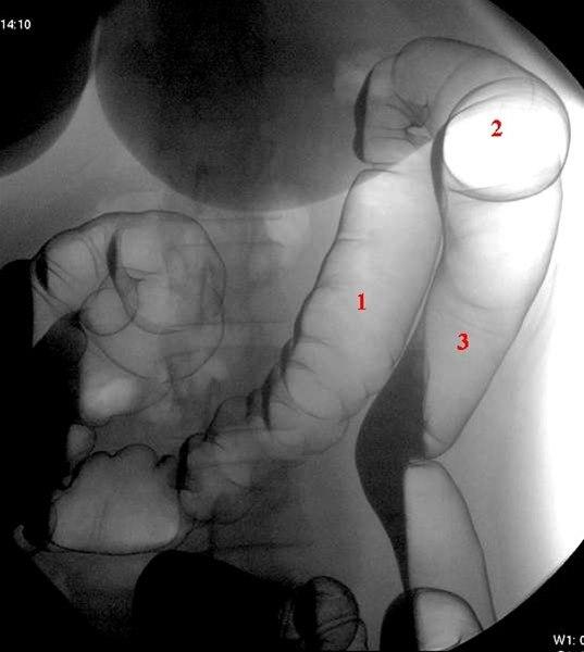 Colon, venstre flexur