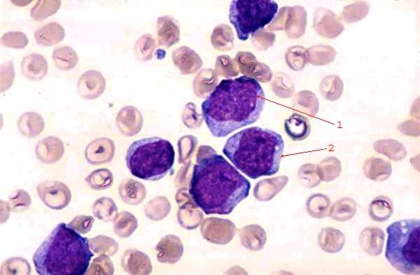 Illustrasjon: Umodne blodceller typisk for blodkreft