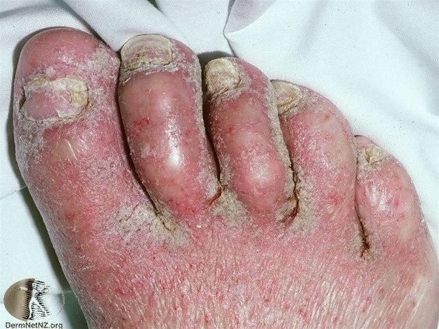 Fotoet viser kronisk dermatitt, uttalt