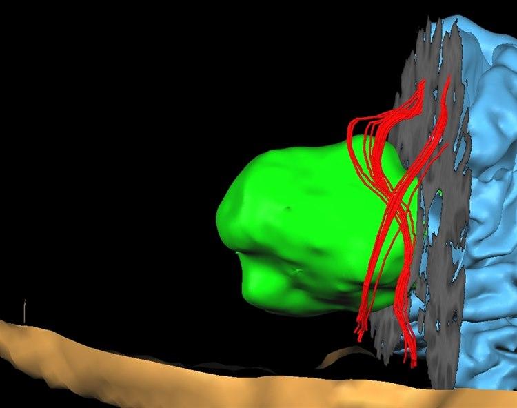 Diffusjons MR kartlegger vannbevegelsen og dermed nervetrådene. Nervetrådene vises her i rødt, svulsten i grønt.